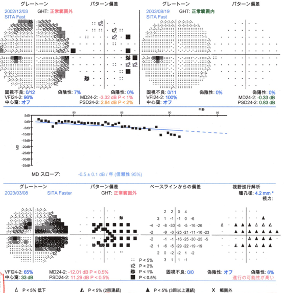 ハンフリー静的視野検査