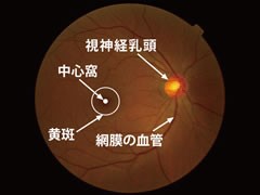 眼底疾患の紹介｜神戸市須磨区の梶川眼科医院