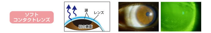 ソフトコンタクトレンズ装用者