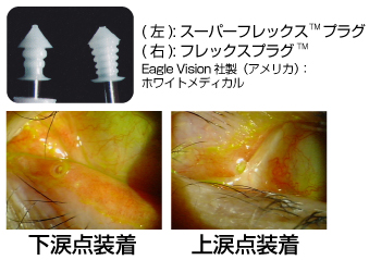 （1）シリコン製涙点プラグ：