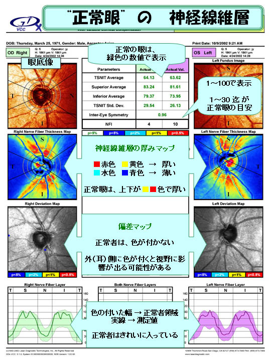 正常眼の神経線維層