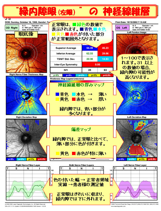 緑内障眼（左目）の神経線維層