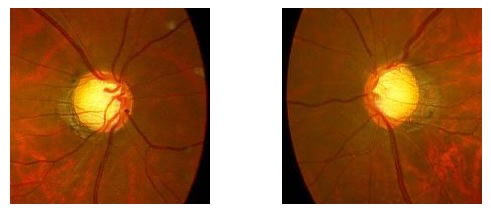 両正常眼圧緑内障（右中期、左初期～中期）