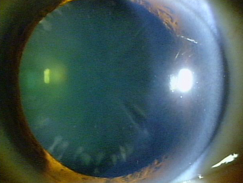 初期：水晶体の周辺部の皮質から濁り始めたところ